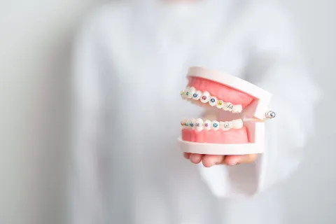 Braces on a model of teeth in the Roark Orthodontics treatment room