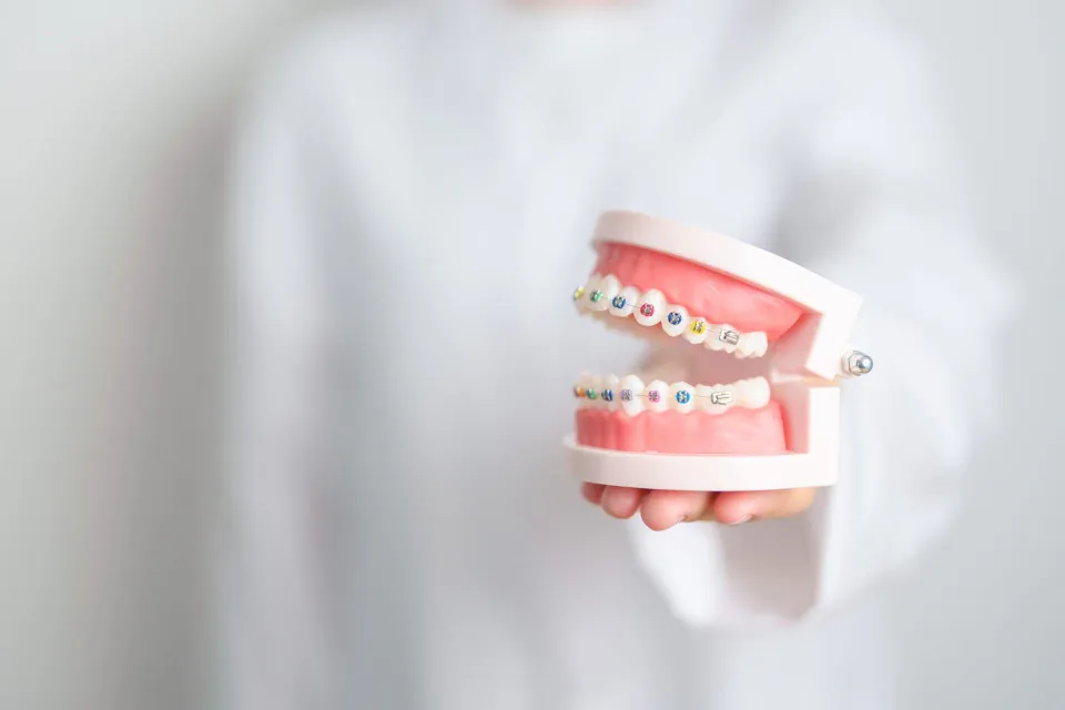 Metal braces on a model of teeth
